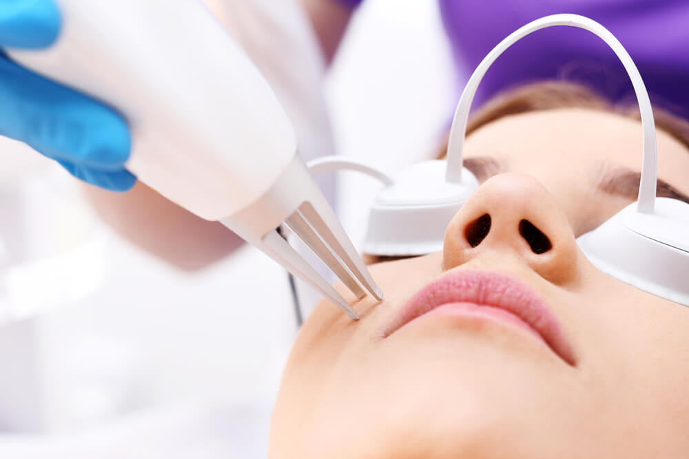 How to Get the Best Acne Laser Treatment?