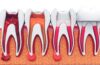 Root Canal Treatment