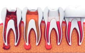 Root Canal Treatment