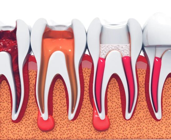Root Canal Treatment