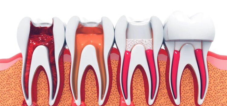 Root Canal Treatment