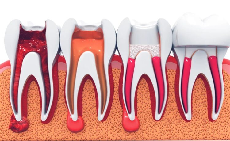 Root Canal Treatment
