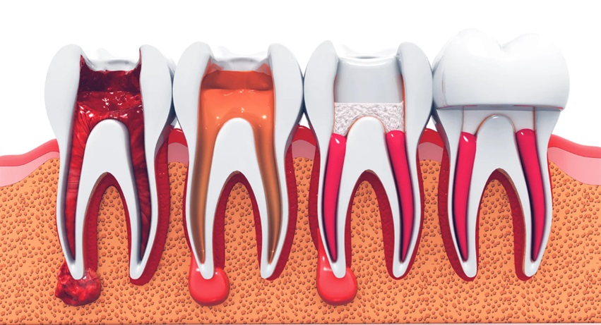 Benefits of Root Canal Treatment for Long-Term for Your Oral Health