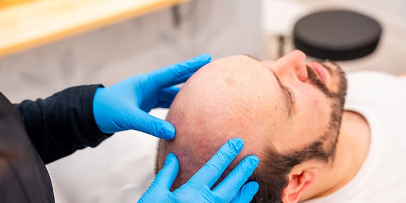 Dubai Hair Transplant: A Professional Month-by-Month Results Timeline and In-Depth Guide