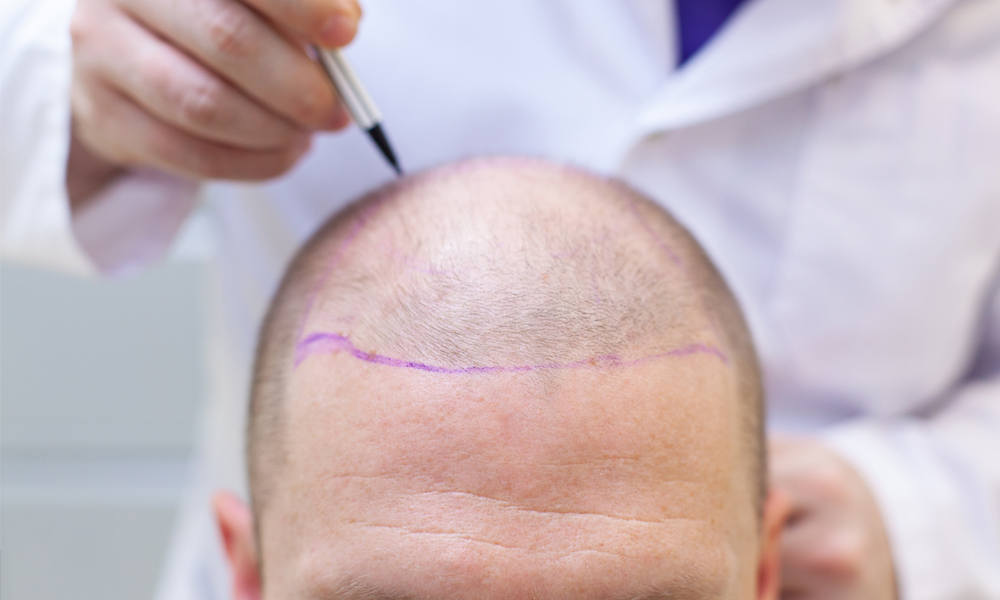 What is PRP Treatment for Hair Loss?