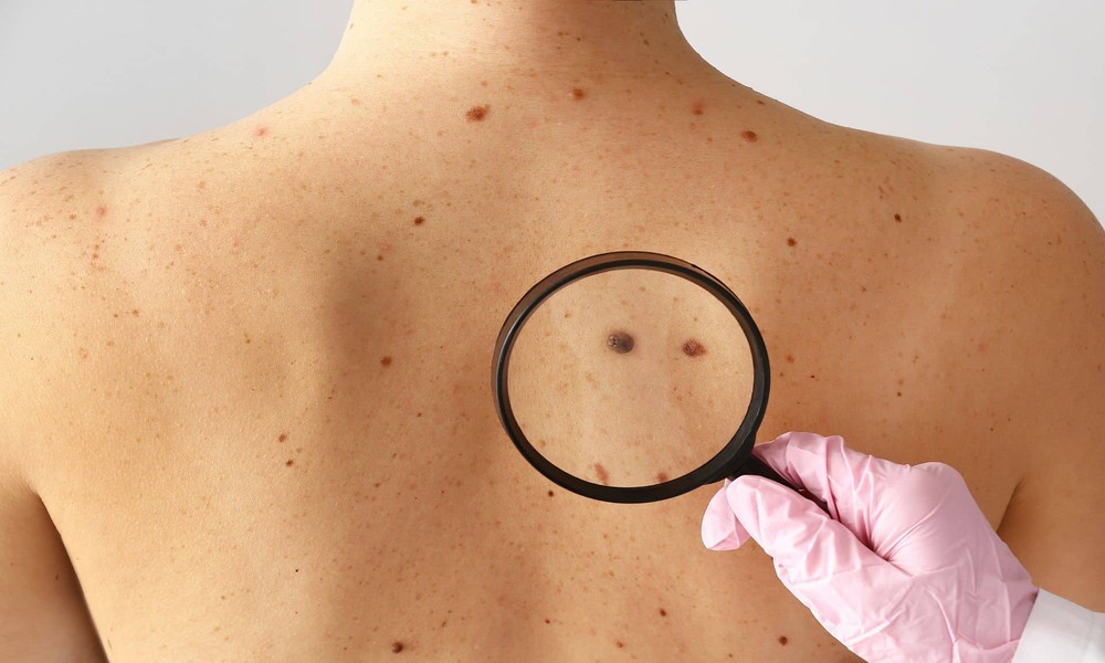 Decoding the ABCDE Rule: A Comprehensive Guide to Early Melanoma Detection